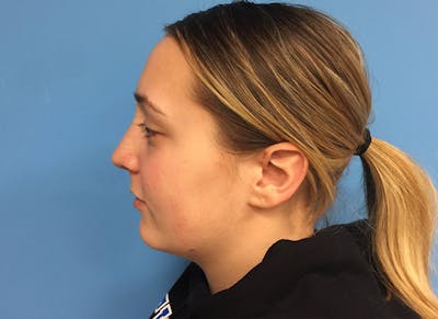 Rhinoplasty Before & After Gallery - Patient 112338611 - Image 2