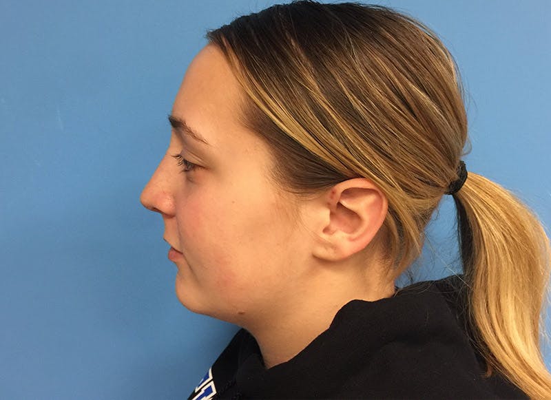 Rhinoplasty Before & After Gallery - Patient 112338611 - Image 2