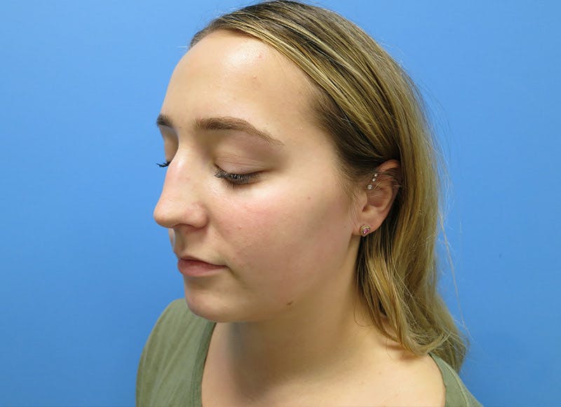 Rhinoplasty Before & After Gallery - Patient 112338611 - Image 3
