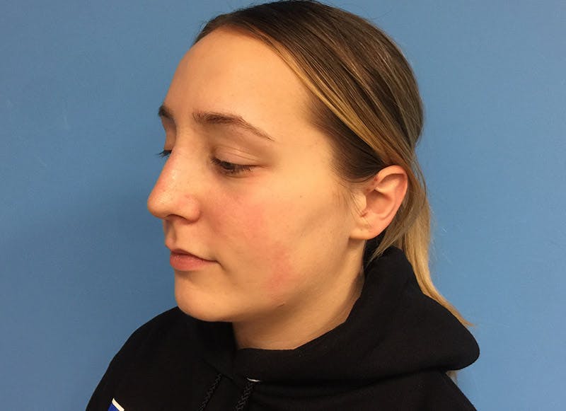 Rhinoplasty Before & After Gallery - Patient 112338611 - Image 4