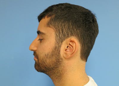 Rhinoplasty Before & After Gallery - Patient 112338612 - Image 1