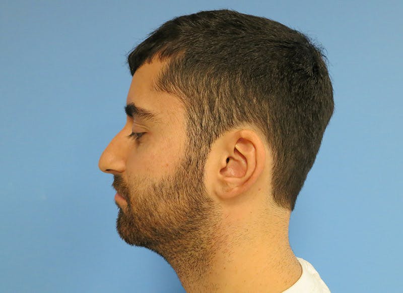 Rhinoplasty Before & After Gallery - Patient 112338612 - Image 1