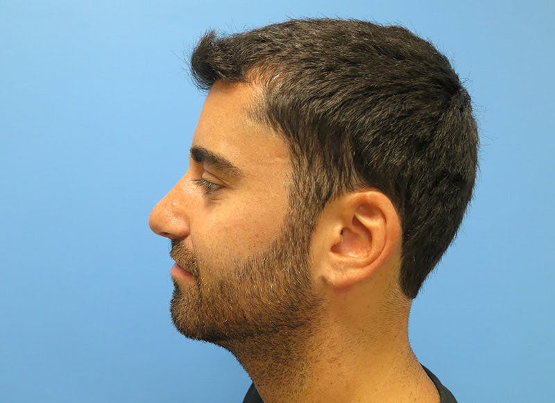 Rhinoplasty Before & After Gallery - Patient 112338612 - Image 2