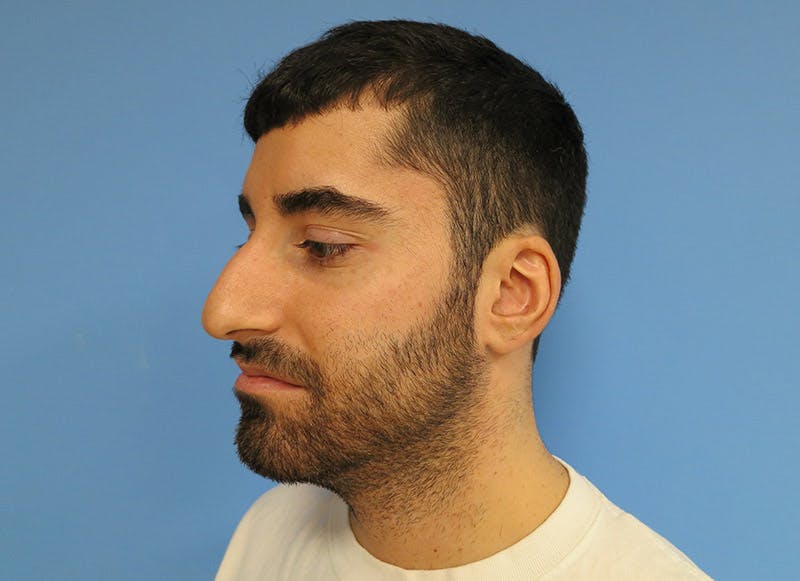 Rhinoplasty Before & After Gallery - Patient 112338612 - Image 3