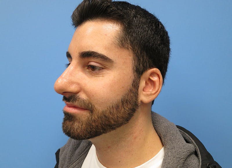 Rhinoplasty Before & After Gallery - Patient 112338612 - Image 4