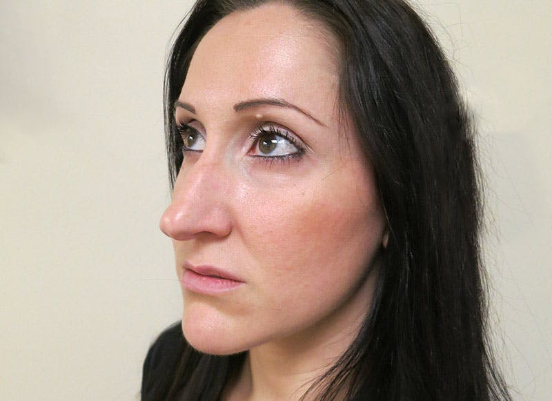 Rhinoplasty Before & After Gallery - Patient 112338619 - Image 3