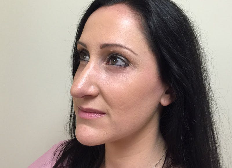 Rhinoplasty Before & After Gallery - Patient 112338619 - Image 4