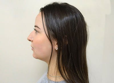 Rhinoplasty Before & After Gallery - Patient 112338626 - Image 1