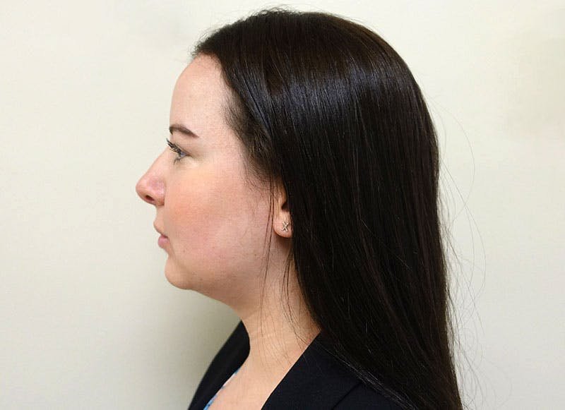 Rhinoplasty Before & After Gallery - Patient 112338626 - Image 2