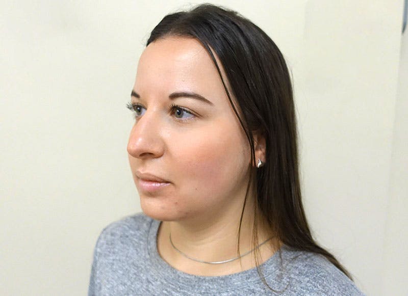 Rhinoplasty Before & After Gallery - Patient 112338626 - Image 3