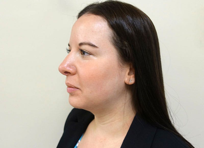 Rhinoplasty Before & After Gallery - Patient 112338626 - Image 4