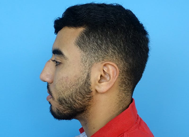 Rhinoplasty Before & After Gallery - Patient 112338660 - Image 1