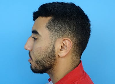 Rhinoplasty Before & After Gallery - Patient 112338660 - Image 1