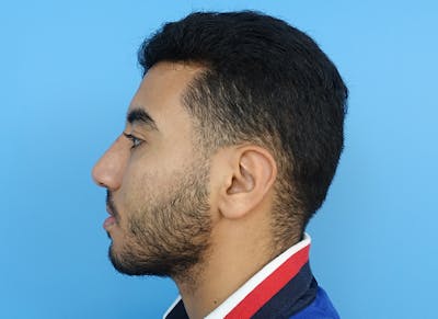 Rhinoplasty Before & After Gallery - Patient 112338660 - Image 2