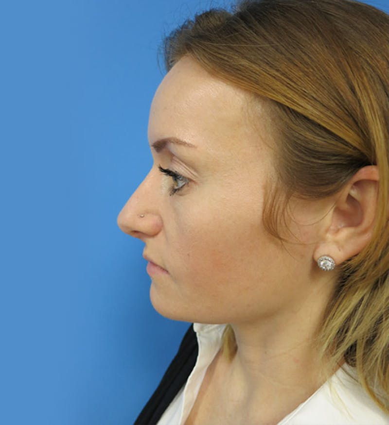Rhinoplasty Before & After Gallery - Patient 112338607 - Image 2