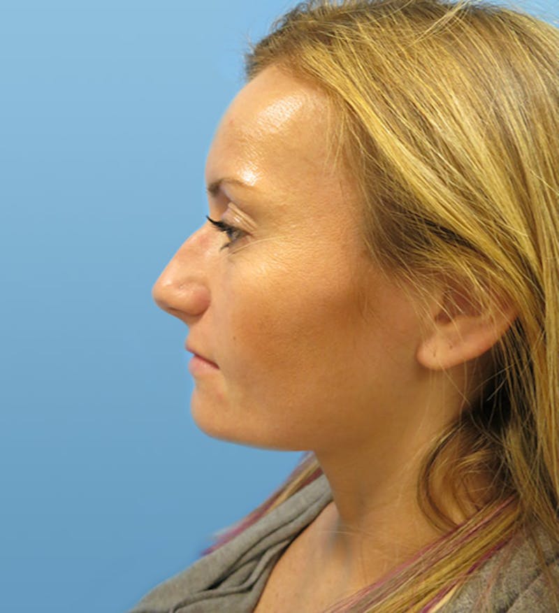 Rhinoplasty Before & After Gallery - Patient 112338607 - Image 1