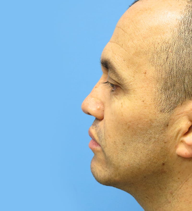 Rhinoplasty Before & After Gallery - Patient 112338616 - Image 2