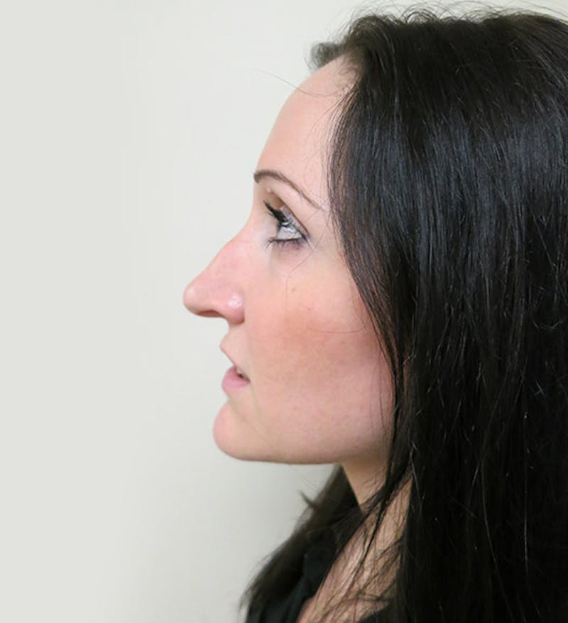 Rhinoplasty Before & After Gallery - Patient 112338619 - Image 1