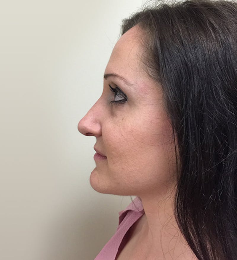 Rhinoplasty Before & After Gallery - Patient 112338619 - Image 2