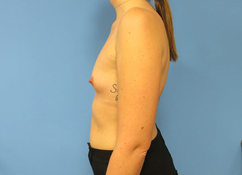 Augmentation Before & After Gallery - Patient 112340402 - Image 1