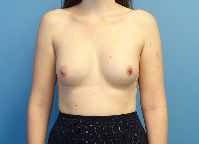 Augmentation Before & After Gallery - Patient 112340402 - Image 6