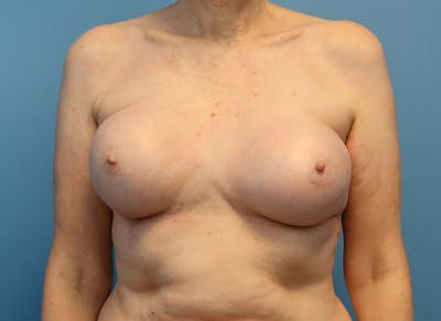 Augmentation Before & After Gallery - Patient 413190 - Image 5