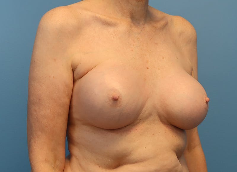 Augmentation Before & After Gallery - Patient 413190 - Image 7