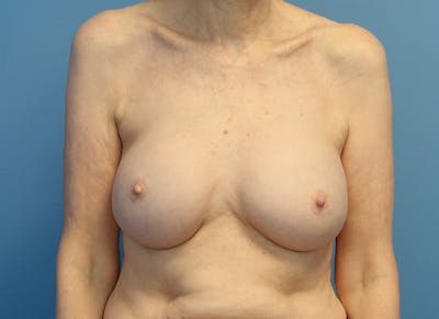 Augmentation Before & After Gallery - Patient 413190 - Image 6