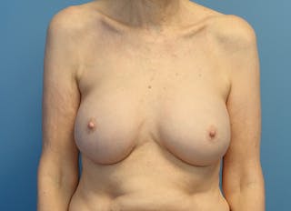 Augmentation Before & After Gallery - Patient 413190 - Image 6