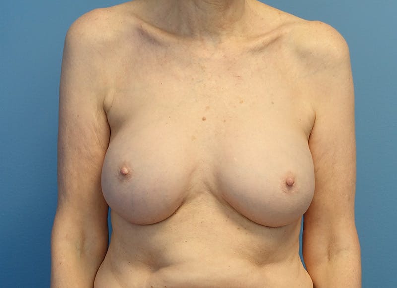 Augmentation Before & After Gallery - Patient 179248822 - Image 6