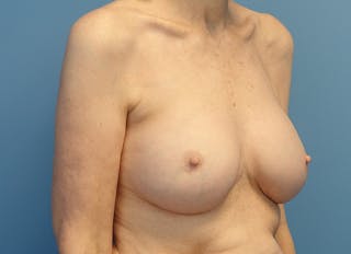 Augmentation Before & After Gallery - Patient 413190 - Image 8
