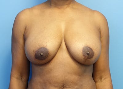 Breast Reduction Before & After Gallery - Patient 179248943 - Image 5