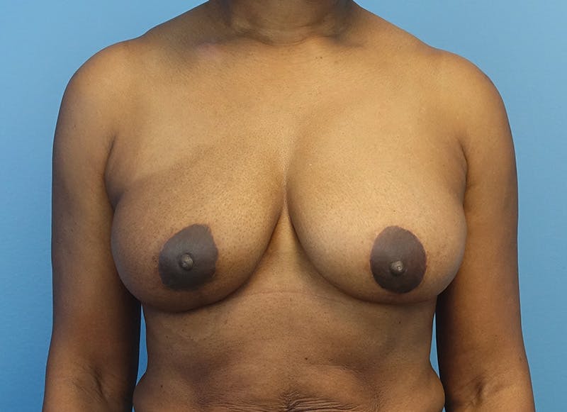 Breast Reduction Before & After Gallery - Patient 179248943 - Image 6