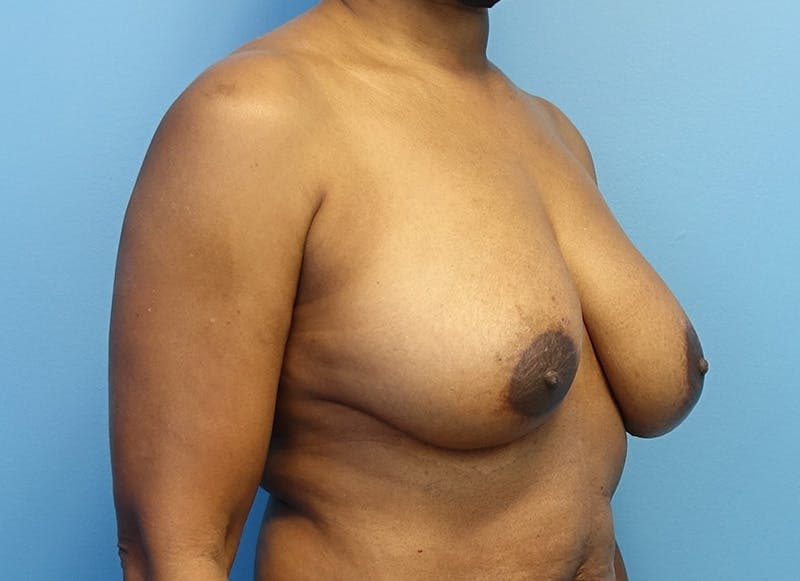 Breast Reduction Before & After Gallery - Patient 179248943 - Image 7
