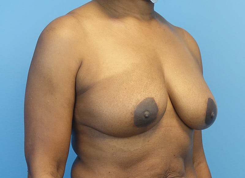 Breast Reduction Before & After Gallery - Patient 179248943 - Image 8