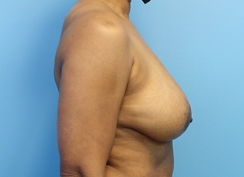 Breast Reduction Before & After Gallery - Patient 179248943 - Image 9