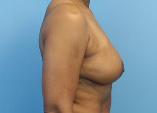 Breast Reduction Before & After Gallery - Patient 179248943 - Image 10