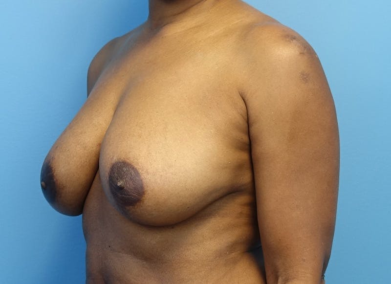 Breast Reduction Before & After Gallery - Patient 179248943 - Image 3