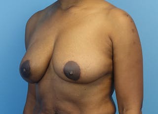 Breast Reduction Before & After Gallery - Patient 179248943 - Image 4