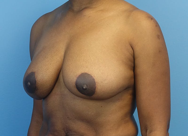 Breast Reduction Before & After Gallery - Patient 179248943 - Image 4