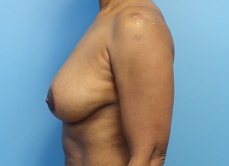Breast Reduction Before & After Gallery - Patient 179248943 - Image 1