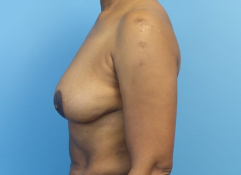 Breast Reduction Before & After Gallery - Patient 179248943 - Image 2