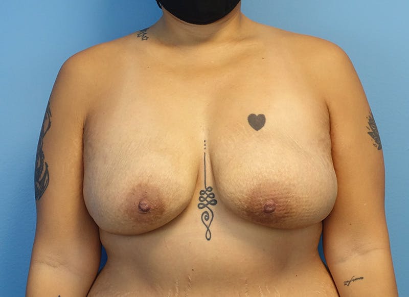 Flap Reconstruction Before & After Gallery - Patient 179250591 - Image 6