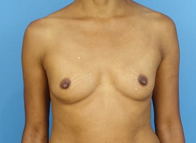 Flap Reconstruction Gallery Before & After Gallery - Patient 179250599 - Image 5