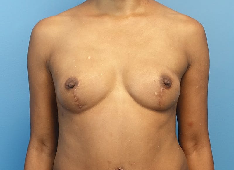 Flap Reconstruction Gallery Before & After Gallery - Patient 179250599 - Image 6