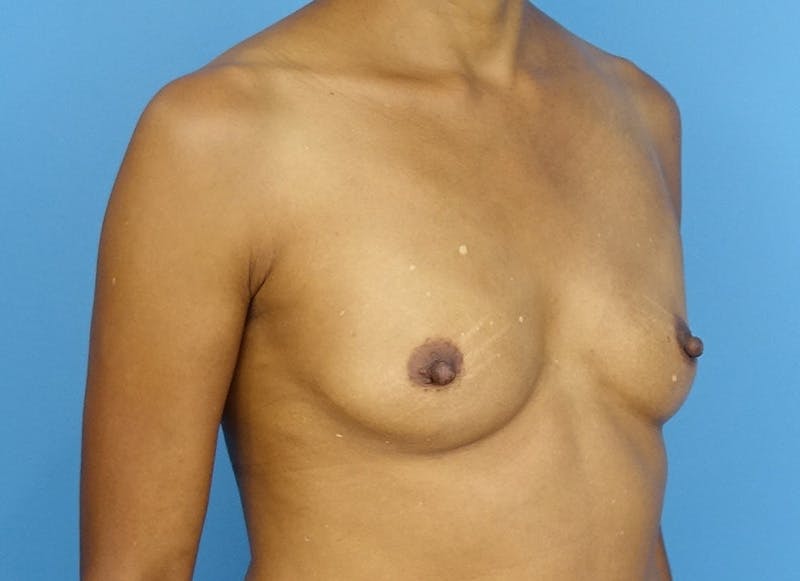 Flap Reconstruction Before & After Gallery - Patient 179250599 - Image 3
