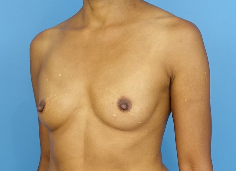 Flap Reconstruction Gallery Before & After Gallery - Patient 179250599 - Image 9