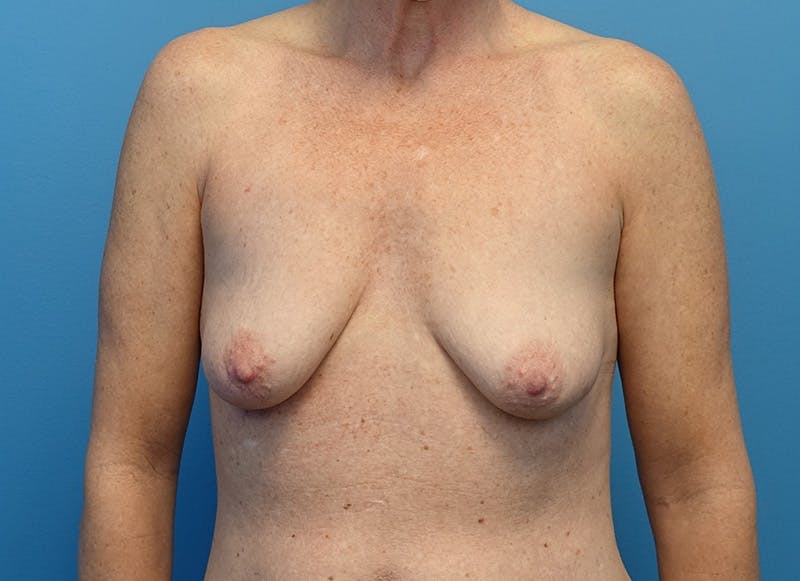 Hybrid Reconstruction Before & After Gallery - Patient 179250602 - Image 5