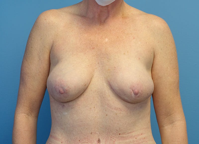 Hybrid Reconstruction Before & After Gallery - Patient 179250602 - Image 6