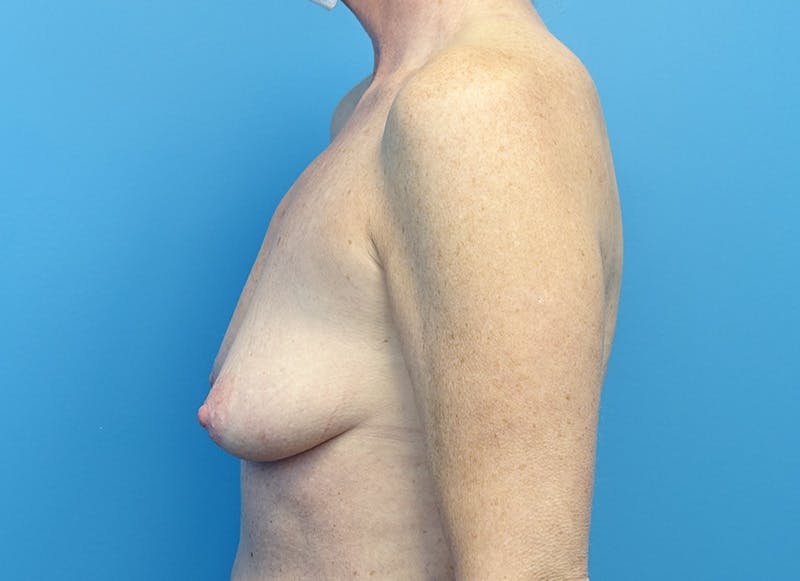 Hybrid Reconstruction Before & After Gallery - Patient 179250602 - Image 1